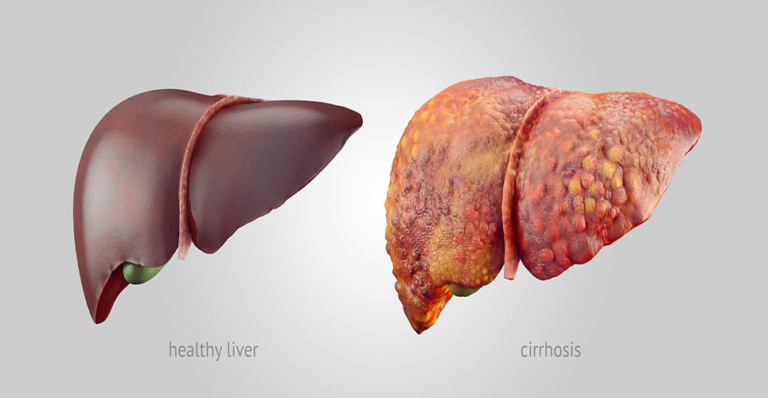 Fatty Liver: Simple Lifestyle Changes That Help Reverse It